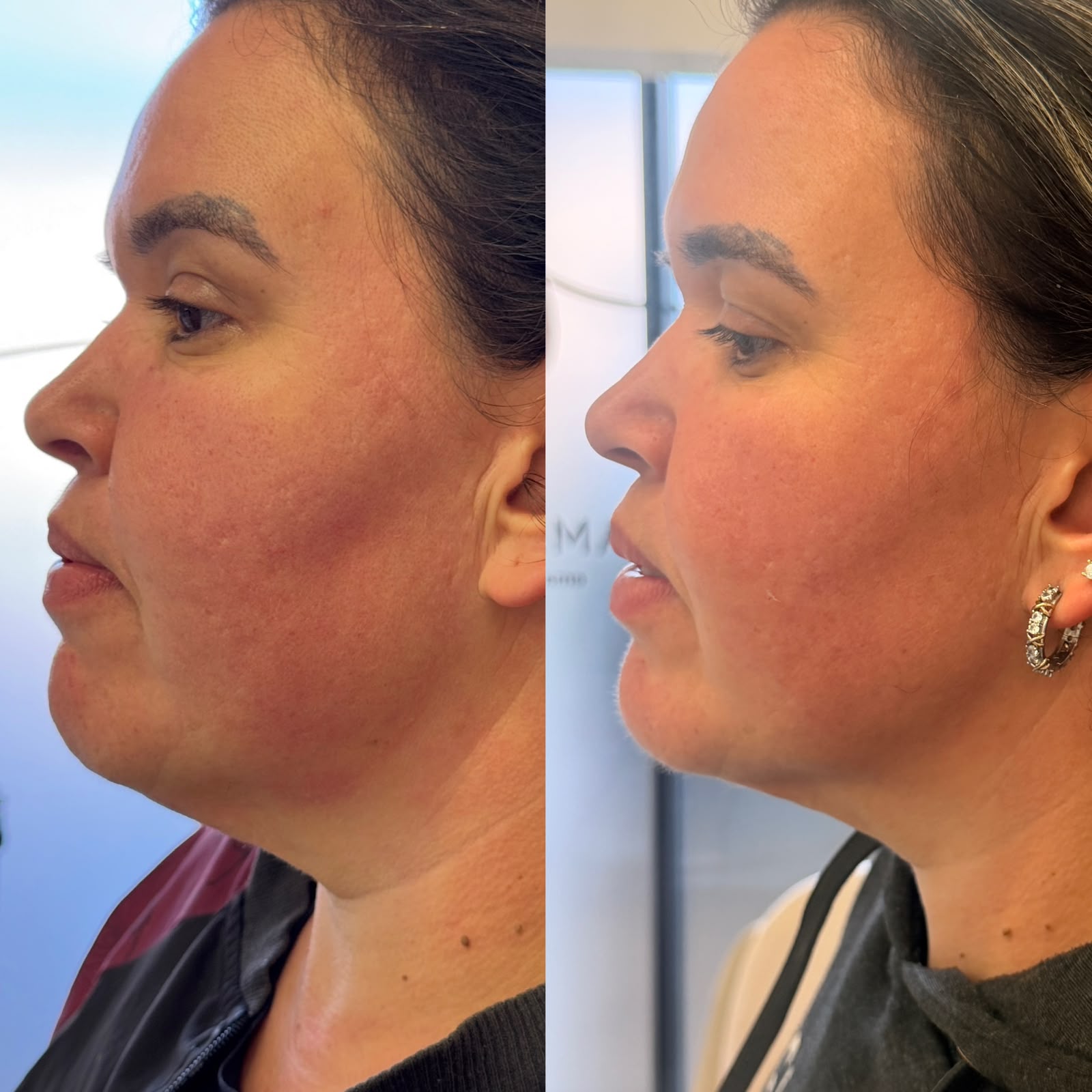Antes e depois — resultado 7