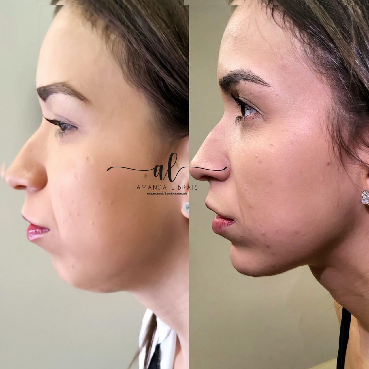 Antes e depois — resultado 2