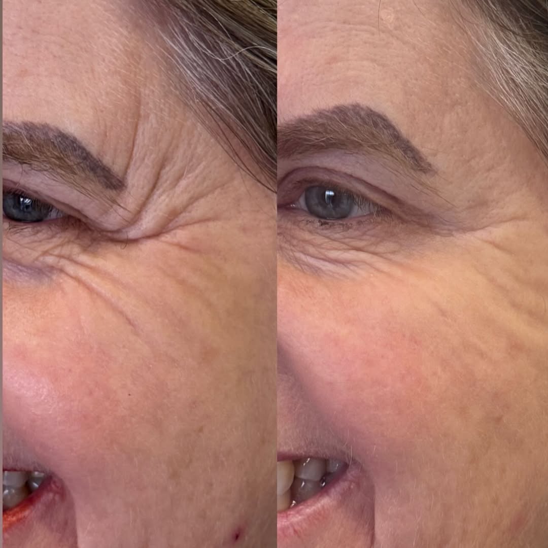 Antes e depois — resultado 5