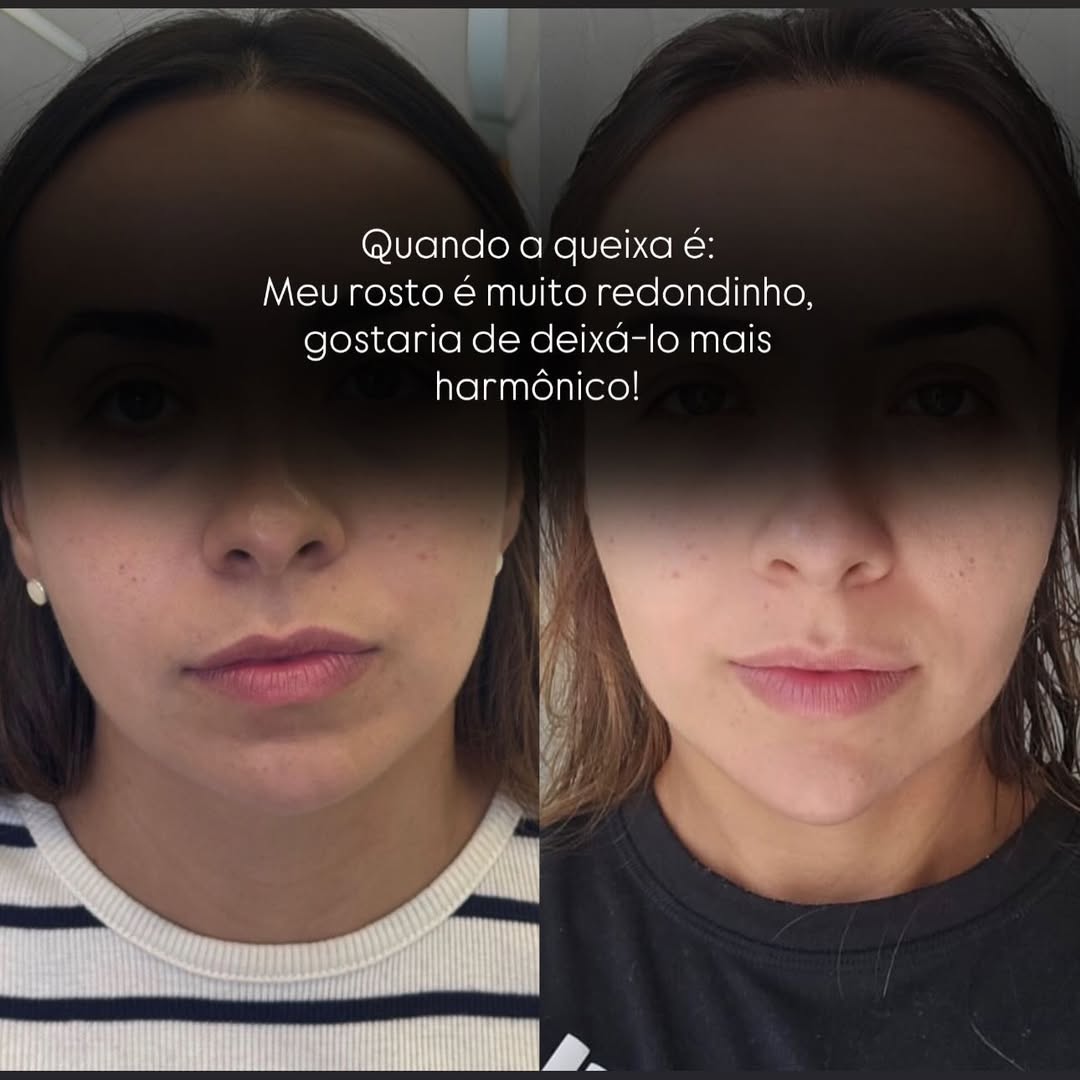 Antes e depois — resultado 3