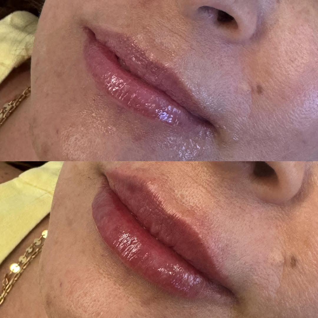 Antes e depois — resultado 6
