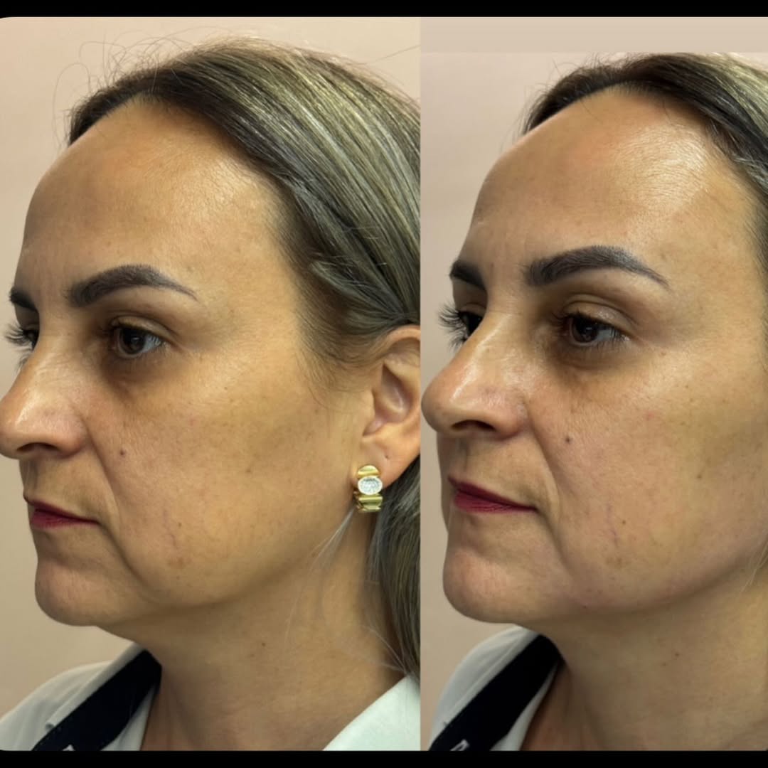 Antes e depois — resultado 4
